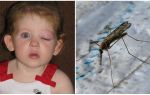 What to do if a child has a puffy eye after a mosquito bite