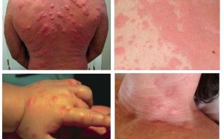 Allergic reaction to bedbug bites