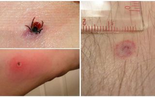 Symptoms and treatment of an encephalitic tick bite in humans