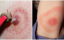 What is Lyme disease, its symptoms, treatment and photo