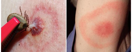 What is Lyme disease, its symptoms, treatment and photo