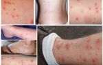 How do flea bites on human skin photo