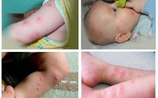 What to do if a child is bitten by a flea, photo bites