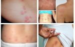 What do bedbug bites look like on human skin?