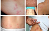 What do bedbug bites look like on human skin?