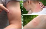 How to remove swelling and itching from mosquito bites in a child and an adult