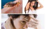 Can lice appear from nerves?