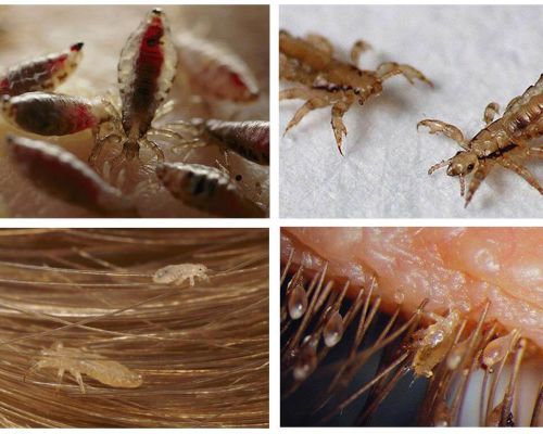 How to quickly remove lice and nits at home