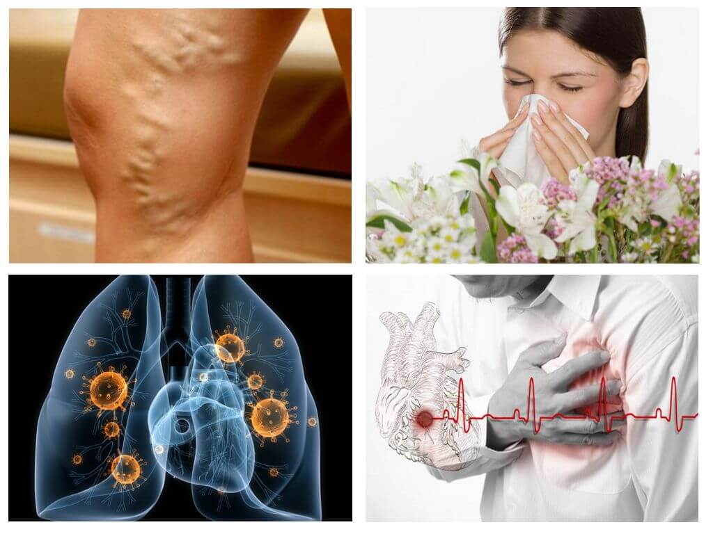 Alergie, srdeční onemocnění, tuberkulóza