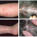 Flea bites and lice bites