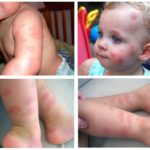 Allergy to bug bites in children