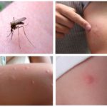 Kousnutí komárů