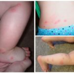 Bedbug bites in children-1