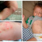 Bedbug bites in children