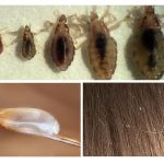 Nits and lice