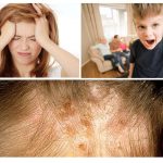Effects of lice