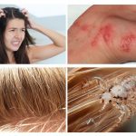 Signs of lice