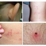 The appearance of various pest bites