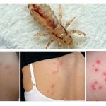 Lice bites on the body