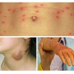 Lice disease