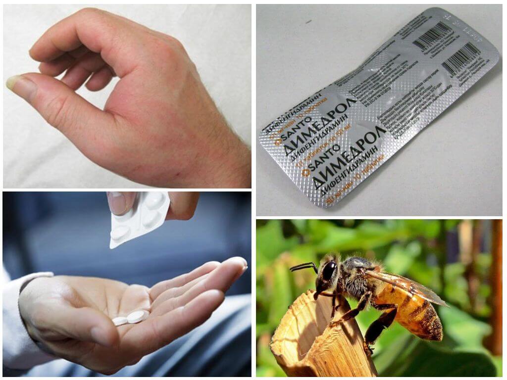 Bites alerģijas ārstēšana