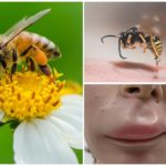 Bee sting in lip