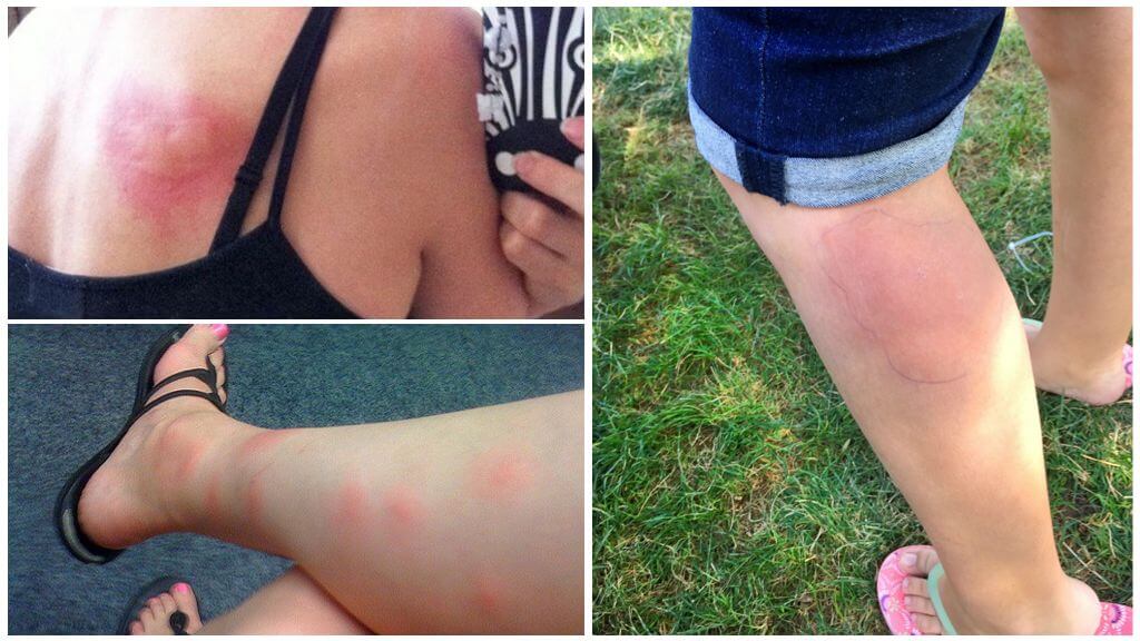 Reacció al·lèrgica a les picades de mosquits