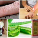 Folk remedies for mosquito bites and blackflies