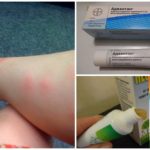 Remedies for mosquito bites