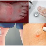 Actions for blistering mosquito bites