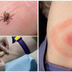 Blood test for borreliosis after a tick bite