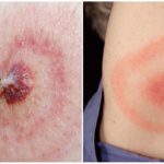 Malaltia de Lyme o Borreliosi transmesa per garrapades