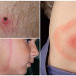 The first signs of borreliosis