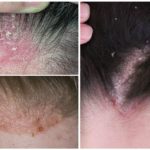 Demodecosis of the scalp