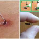 Tick ​​removal