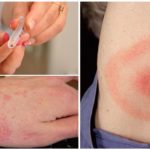 Diseases caused by tick bites