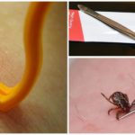 Tick ​​removal with special tools