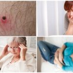 Initial signs of tick-borne diseases