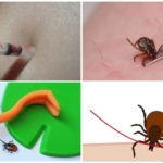Ways to remove ticks