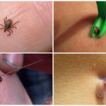 Ways to extract a tick at home