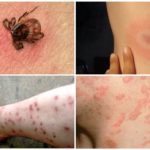 Tick-borne diseases