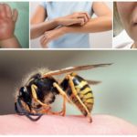 Reaction to a wasp sting in a child