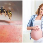 Wasp bite during pregnancy
