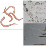 Pinworms in humans