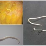 Appearance of pinworms