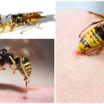 Wasp and bee sting