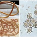 Roundworm and their eggs